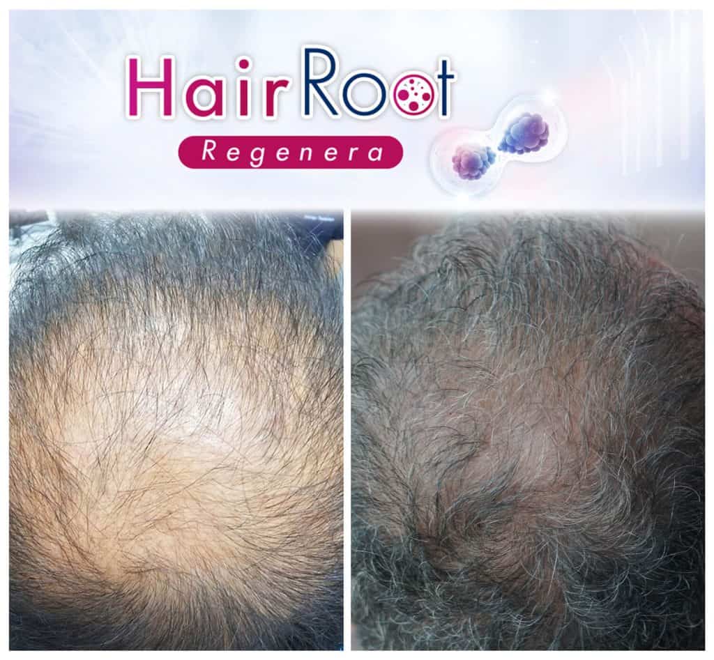 รีวิวการรักษา Hair Root Regenera 1