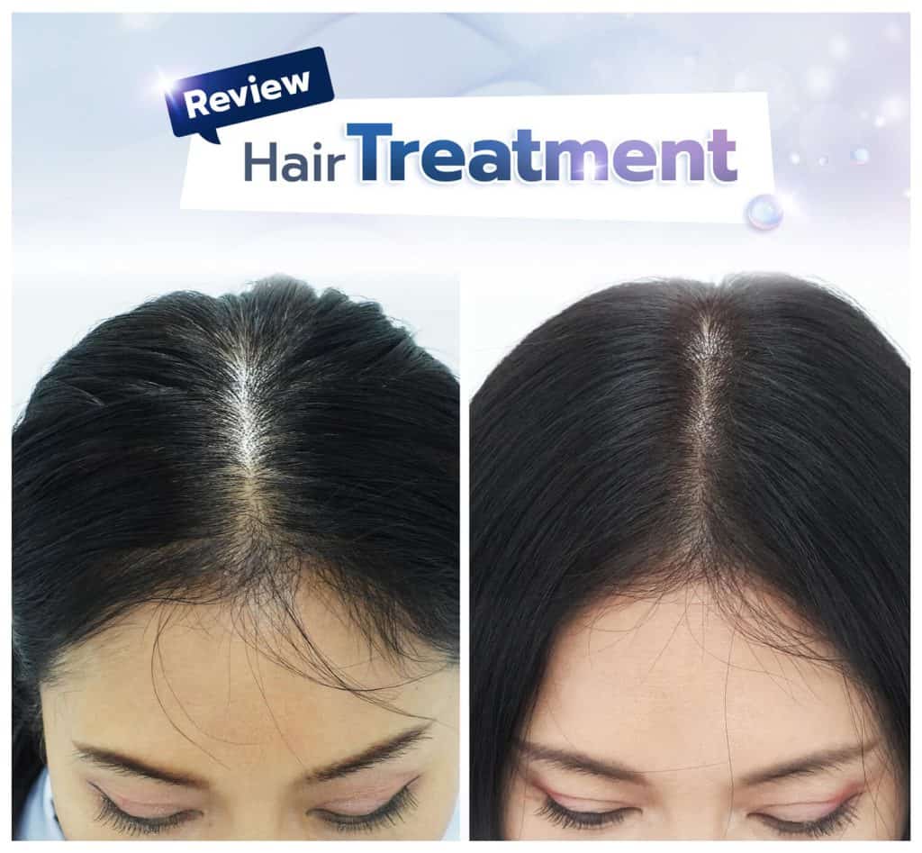 รีวิวการรักษา Hair Treatment 101-105