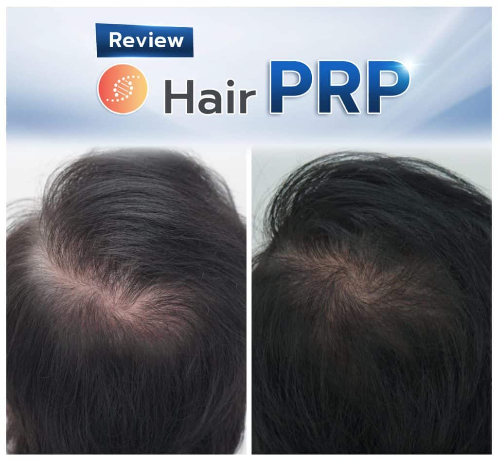 รีวิวการรักษา PRP Hair 1